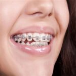 تركيب-تقويم-الاسنان