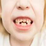 أسباب-تصبغ-الاسنان-عند-الاطفال