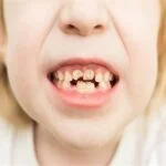 أسباب-تصبغ-الاسنان-عند-الاطفال