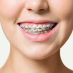 تقويم-الاسنان-الديمون