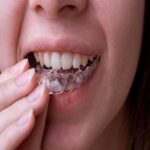 تقويم الشفاف انفزلاين