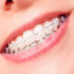 تقويم-الاسنان-الخزفي