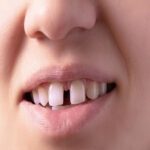 فراغات بين الاسنان