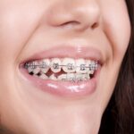 شروط تركيب تقويم الاسنان