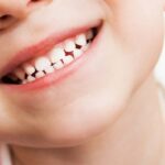 تأخر سقوط اسنان الأطفال