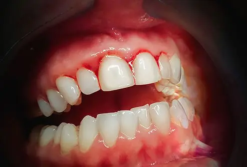 أعراض التهاب اللثة الحاد